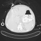 Variceal bleeding, Segstaken tube, liver cirrhosis, portal hypertension, varices, ascites, rectal tube: CT - Computed tomography
